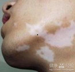 吃黑瓜治疗白癜风吗,揭秘白癜风患者的天然食疗方案